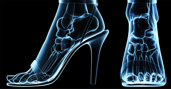 What High Heels Do To Your Body!