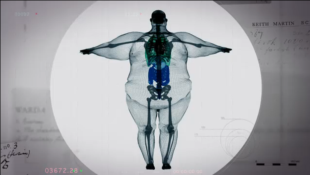 This Is What A 980-Pound Man Looks Like On The Inside