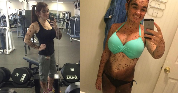 She Has A Very Rare Skin Condition, But She Will NOT...