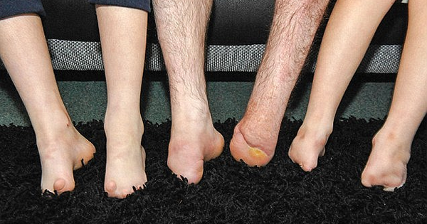 They Were Born WITHOUT FEET. This Year, Dad Has The Perfect Christmas Gift