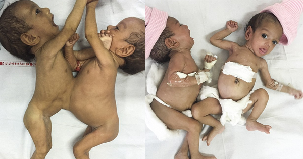 Conjoined At The Liver, These Twins Are Now Successfully Separated At Just Three Months Old