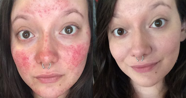 Nothing Helps Treat Her Bumpy Red Skin. Then She Tries One More Super Simple Treatment...