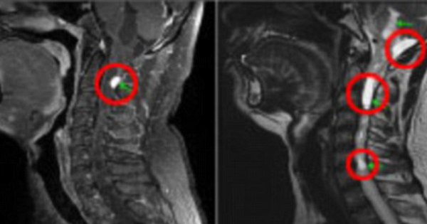 Man Has Hiccups For FIVE DAYS Straight Before An MRI Finally Spots Something On His Neck