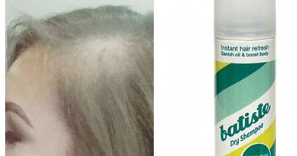 Woman Starts Going BALD After Using This Super Popular Hair Product