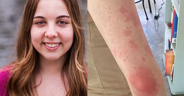 woman-who-goes-into-anaphylactic-shock-from-weather-changes-finally