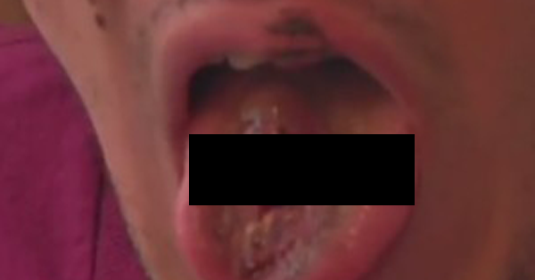 He Was In The Middle Of A Vaping Session When All Of A Sudden, It Exploded IN HIS MOUTH...