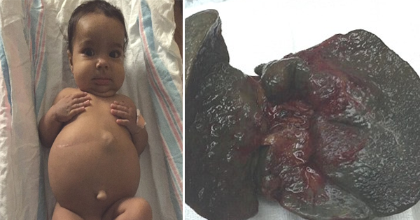 Baby Is Born With A Massively Swollen Stomach And Yellow-Tinged Skin. That