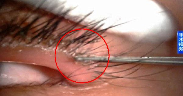 When She Complains Of Slimy Eyes, Her Doctor Discovers Lice Living In Her Eyelashes