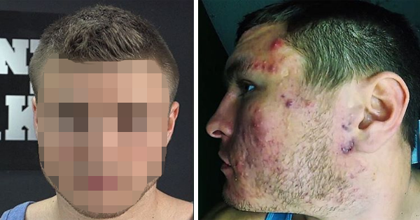 He Was Sick And Tired Of His Acne Problems, So He Made A Simple Change To His Diet And It Went Away