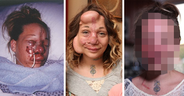 Doctors Surgically Insert Balloons Under Her Skin. Four Months Later, She Looks Completely Different