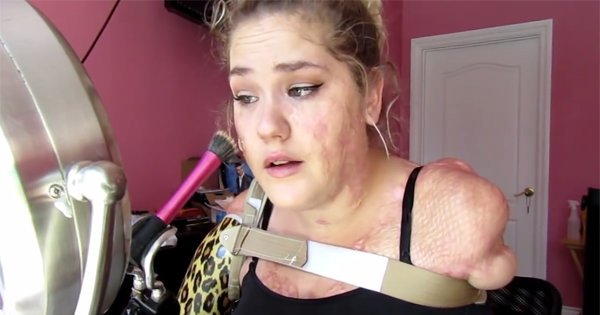 She Loses All Four Limbs In A Span Of 24 Hours When Disease Ravages Her Body. Now, She