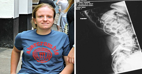 She Broke Her Spine When She Was 9, But Doesn