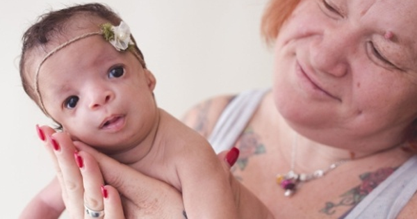 Shes Born With A Facial Deformity So Severe Her Adoptive Mother Backs 