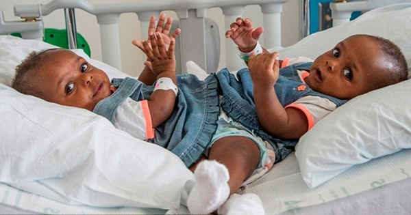 Just Before They Turn One, These Conjoined Twins Are Given A Chance At A New Life