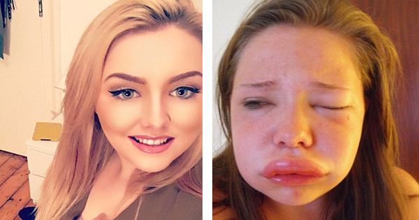 Her Face Keeps Swelling To Double Its Normal Size, But Doctors Have No Clue Why It