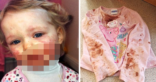 After Being Kissed, This 3-Year-Old Girl Develops A Skin Condition That Looks Like It