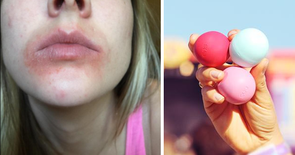 Update: After Customers Get Painful Rashes And Blisters From EOS Lip Balm, EOS Finally Agrees To Pay Compensation