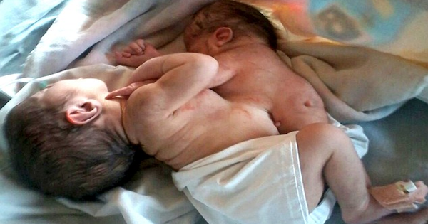 Doctors Are Stunned When This Child Is Born With A Parasitic Twin Attached To His Chest