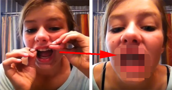 Dentists Are Horrified That Teens Are Making DIY Braces At Home