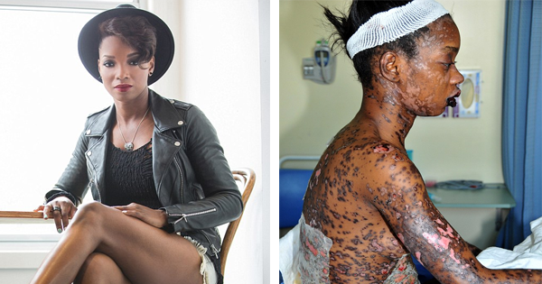 Doctors Prescribe Her Antibiotics. 10 Days Later, She Starts Losing Her Skin