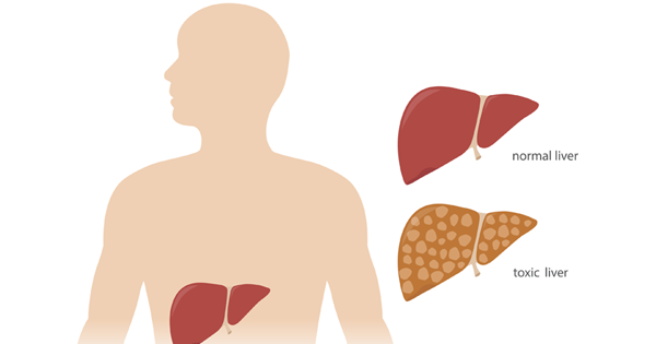 You Might Be Overburdening Your Liver With Toxins, Causing Yourself To Gain Weight