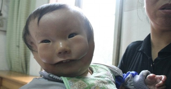 This Little Boy Was Born With A Birth Defect That Makes It Look Like He Has 2 Faces. After 7 Years, Doctors Are Finally Trying To Restore His Appearance