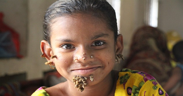 A Little Girl Is Growing Roots All Over Her Face. Her Parents Are Desperate To Find A Doctor Who Can Save Her.