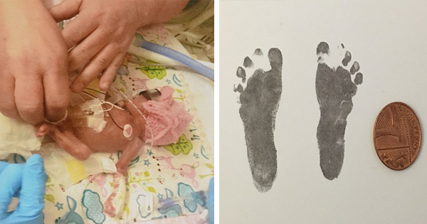 When Her Daughter Is Born Premature, Her Feet Are Barely The Size Of Pennies. Doctors Have No Idea If They