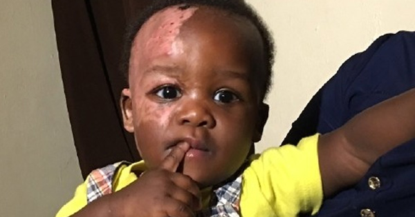 Daycare Tells Mom Her Baby Is Suffering From A Fever. But Then She Looks At The Other Side Of His Face
