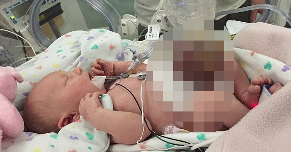 Doctors Deliver This Baby In A Plastic Bag Because Half Her Organs Don