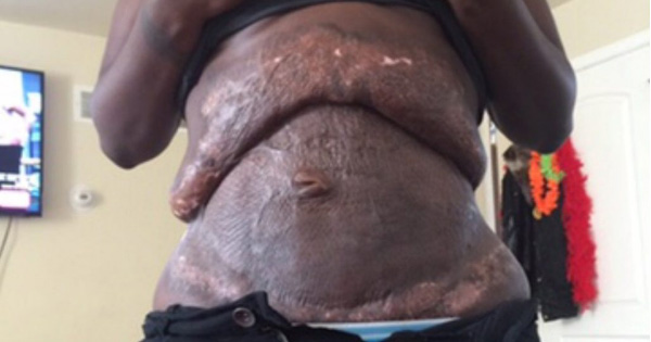 4 Days After Her Tummy Tuck, She Feels Like Her Skin Is Ripping Apart. When She Goes To The Hospital, She Discovers The Truth