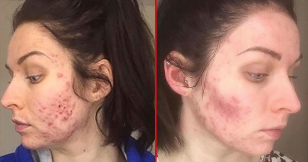 To Get Her Face To Clear Up From Acne, She Has To Give Up Something—And Her Boyfriend