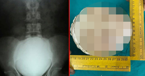 Doctors Find A Mysterious Ball Inside His Stomach. In Order To Remove It, A Crowbar Has To Be Used.