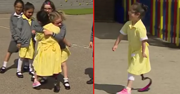 This Little Girl Is So Excited To Show Her Friends Hew New Prosthetic Legs