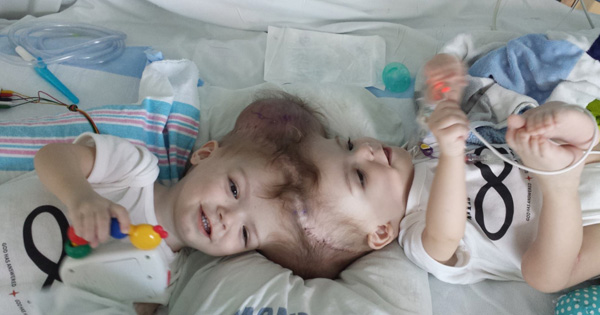 Parents Quit Their Jobs To Care For Their Conjoined Twins. 27 Hours Later, The Boys Are Wheeled Out Of Surgery