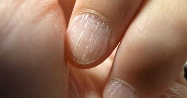 8 Things Your Nails Are Trying To Tell You About Your Health